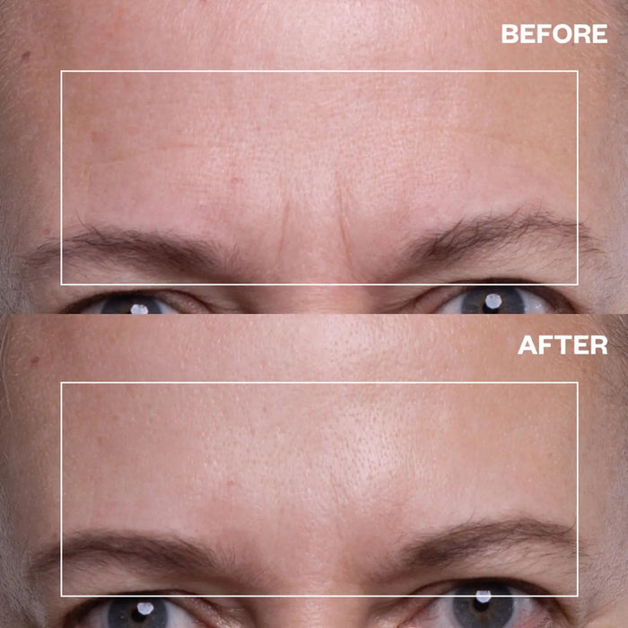 Forehead Wrinkle Patches