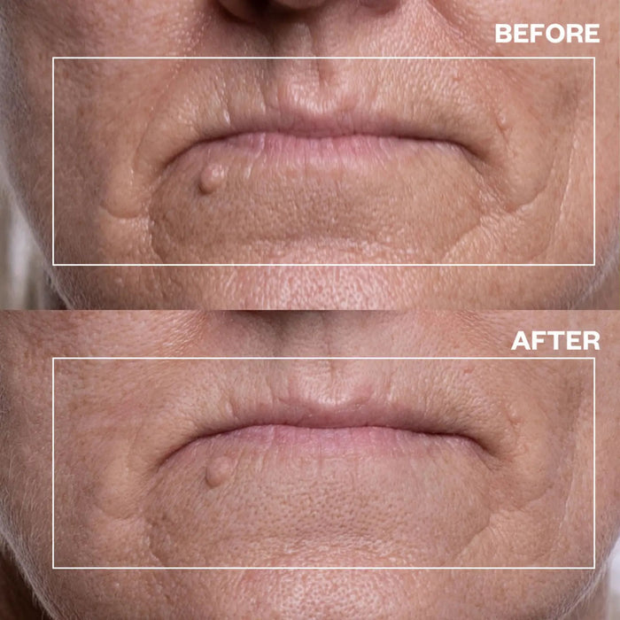 Mouth & Lip Wrinkle Patches